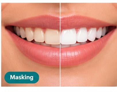 Smile enhancement procedure improving the appearance of stained or uneven teeth.