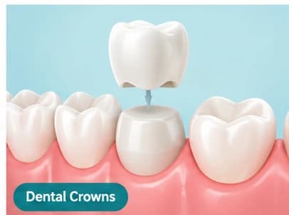 Dental Crowns Dental crown restoration being placed to protect a damaged tooth.